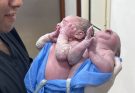 Twins baby born