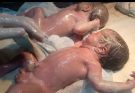 Twin Newborn Babies First Assessment | NICU Receiving & Initial Checkup