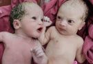 Twin female babies immediately after birth || one is fed up of her sister cry.